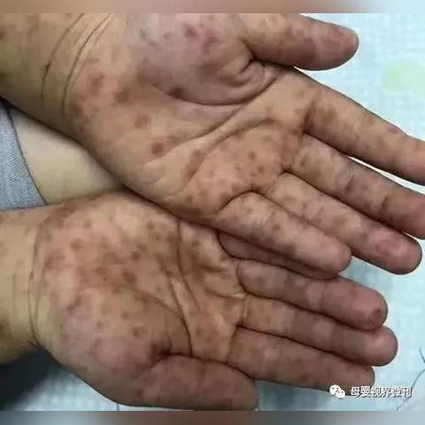 最新病毒感染什么症状(人体病毒感染有什么症状) 最新病毒感染什么症状(人体病毒感染有什么症状)